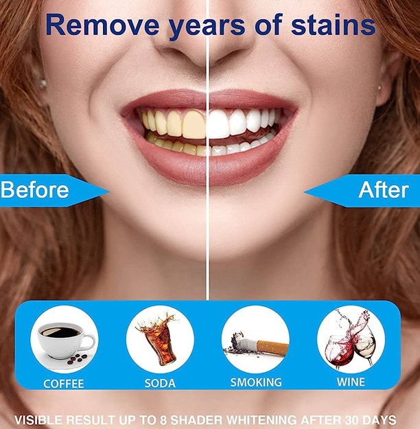 Teeth Whitening Strips Before and After