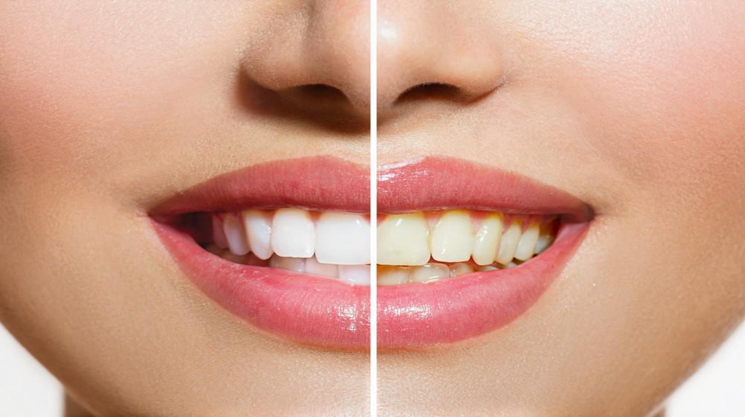 How to Use a Dental Whitening Kit