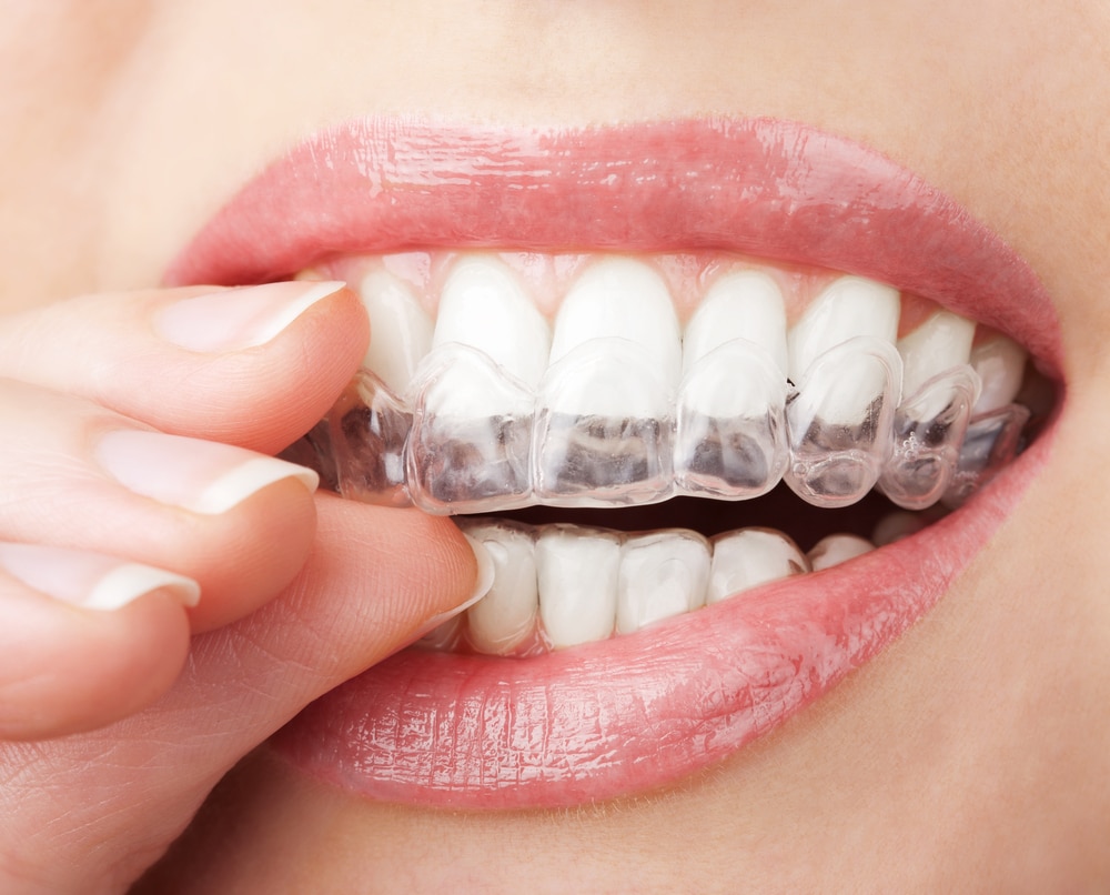 What Do Teeth Whitening Strips Do?cid=15