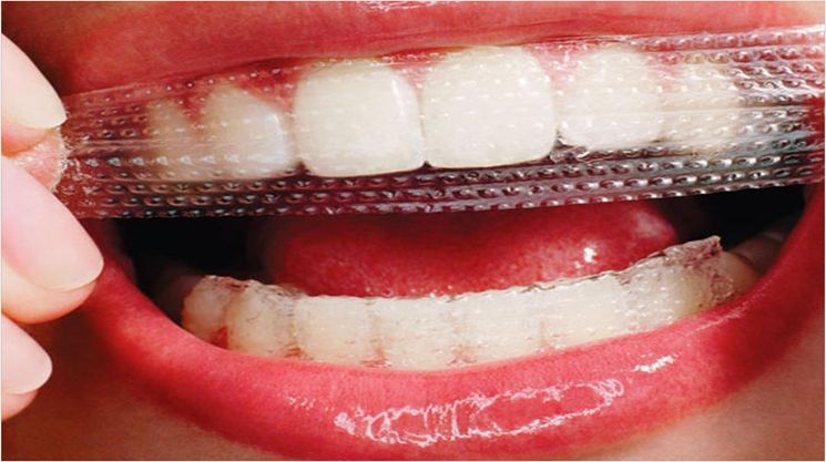 What Do Teeth Whitening Strips Do?