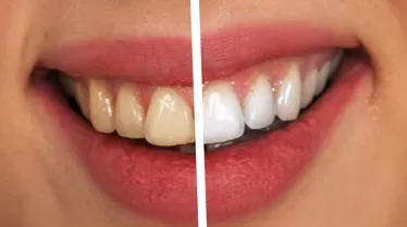 Teeth Whitening For Coffee Lovers: Remove And Prevent Stains