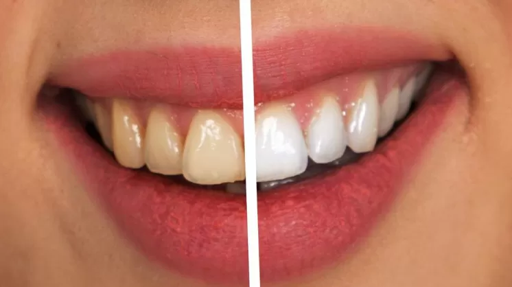 Teeth Whitening For Coffee Lovers: Remove And Prevent Stains