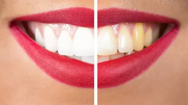 FDA Classifications for Teeth Whitening Pen: Approved, Licensed, and Regulated