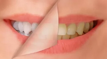 Can I Use A Whitening Pen With Veneers, Crowns, Or Bonding?