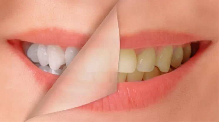 Can I Use A Whitening Pen With Veneers, Crowns, Or Bonding?