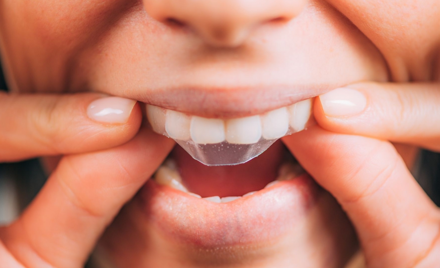 Whitening Strips vs Professional Whitening