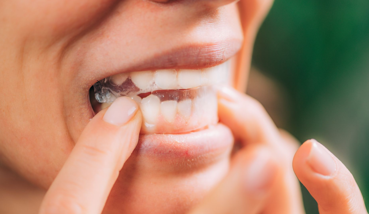 Why Non-Peroxide Whitening Strips Are the Future of At-Home Oral Care