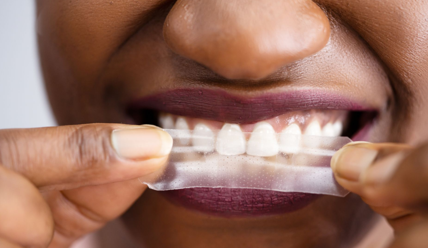 Why Non-Peroxide Whitening Strips Are the Future of At-Home Oral Care