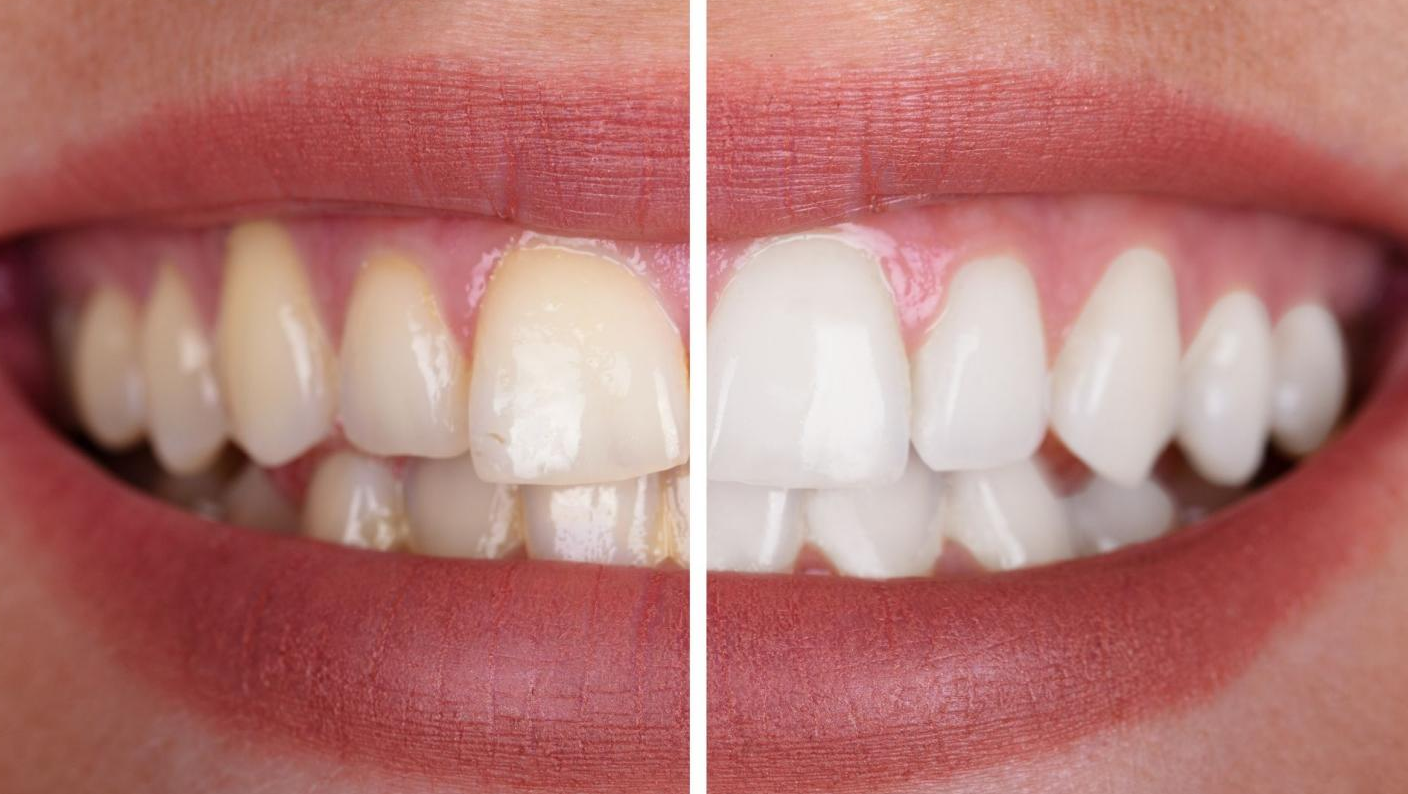 Dental Perspective: Are Non-Peroxide Whitening Strips As Effective As Peroxide Ones?cid=15