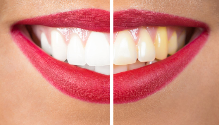 FDA Classifications for Teeth Whitening Pen: Approved, Licensed, and Regulated